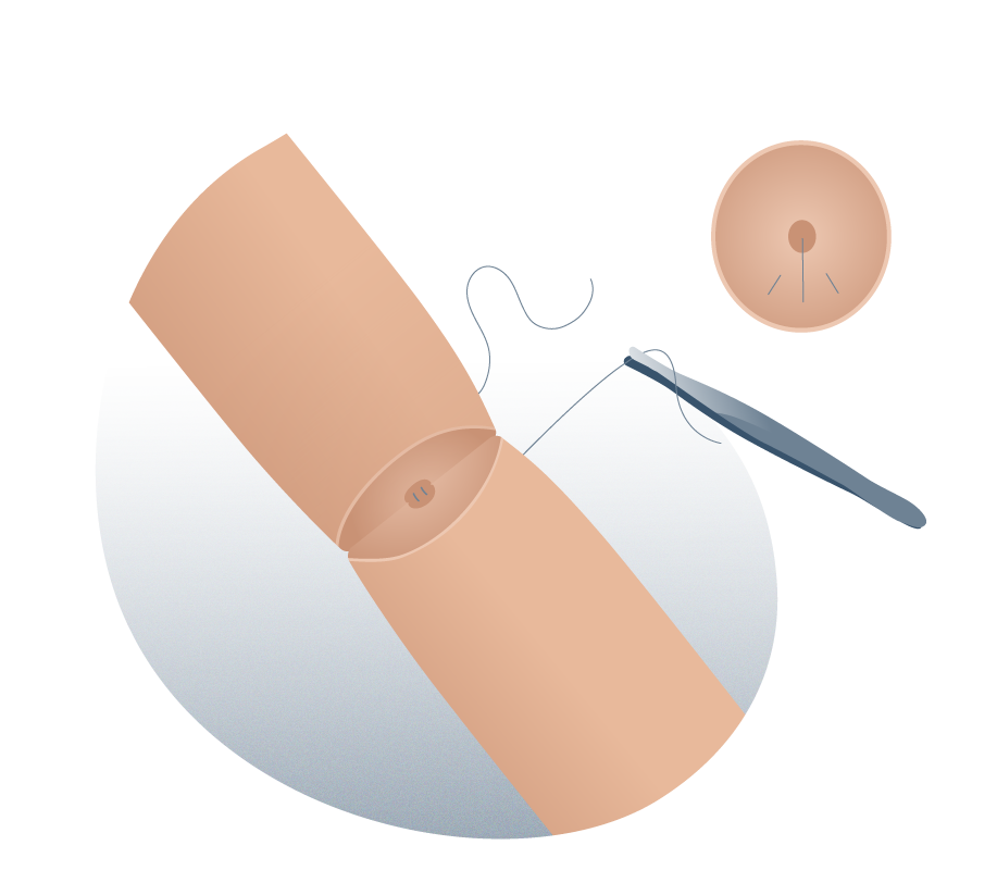 Microcirugía de reversión de cirugía - Paso 2