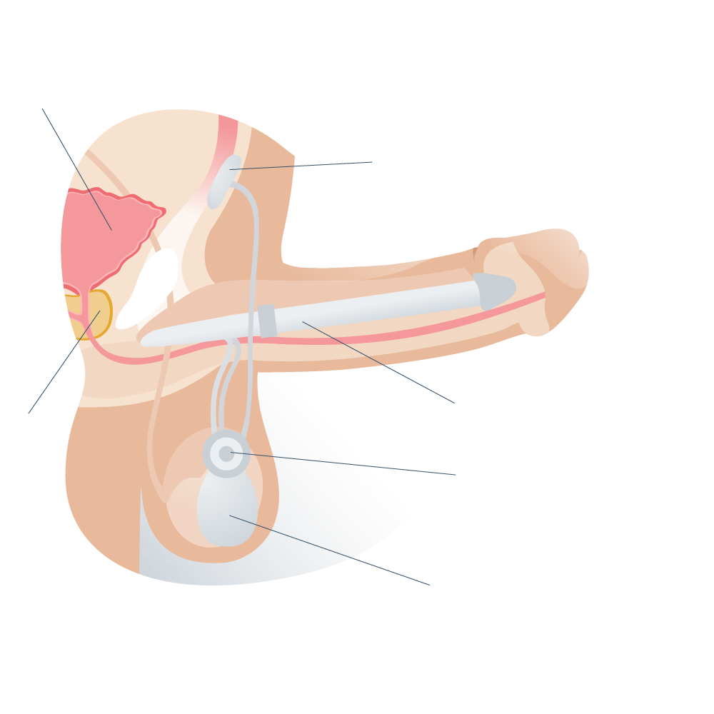 Partes de una protesis de pene hidraulica activada