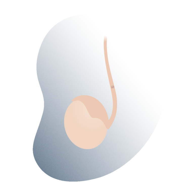 Vasectomy Reversal Andromedi