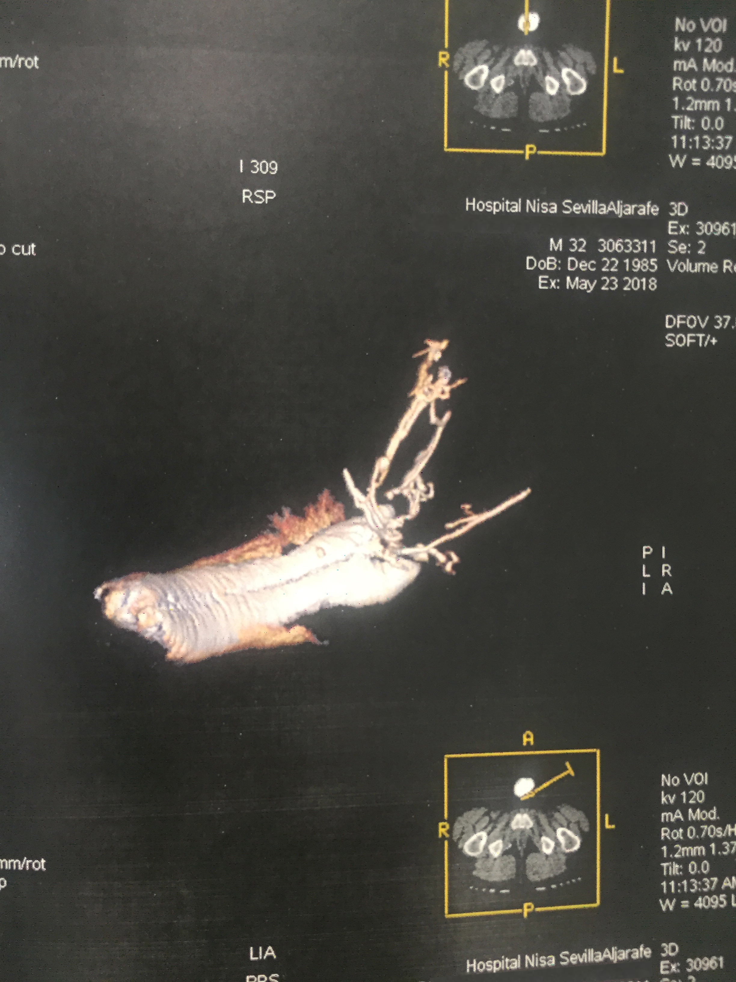 Venous Leak – Andromedi