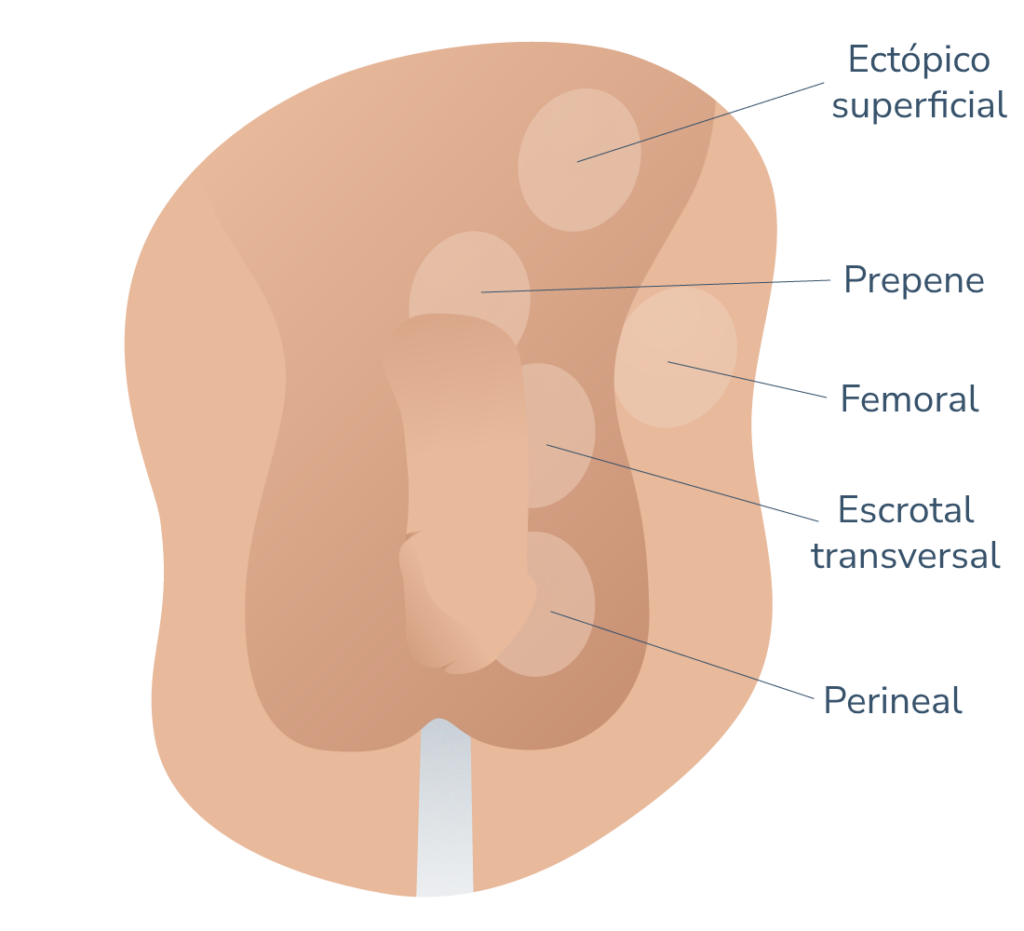 Maldescenso testicular ectopico