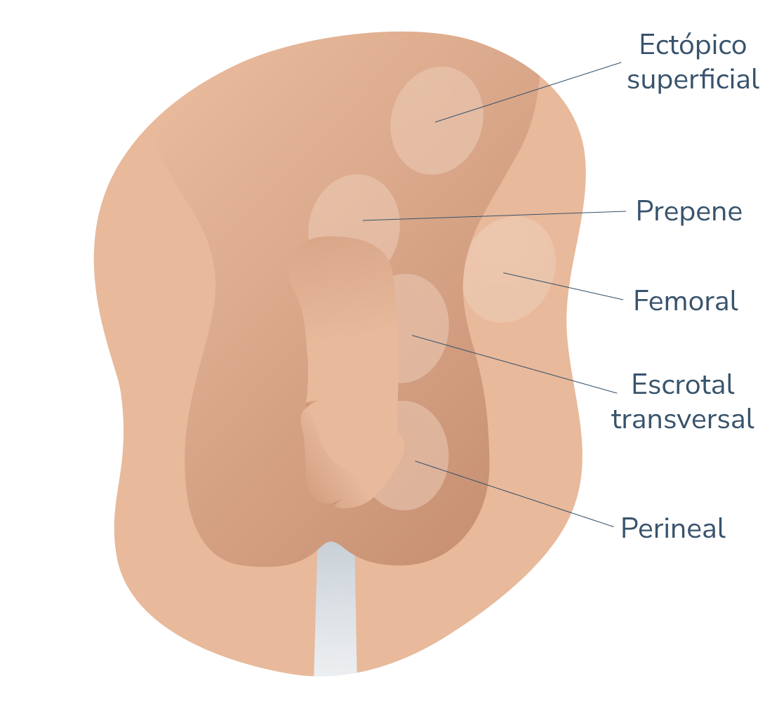 Maldescenso testicular ectopico