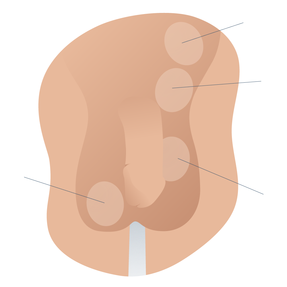 Clasificación del maldescenso testicular
