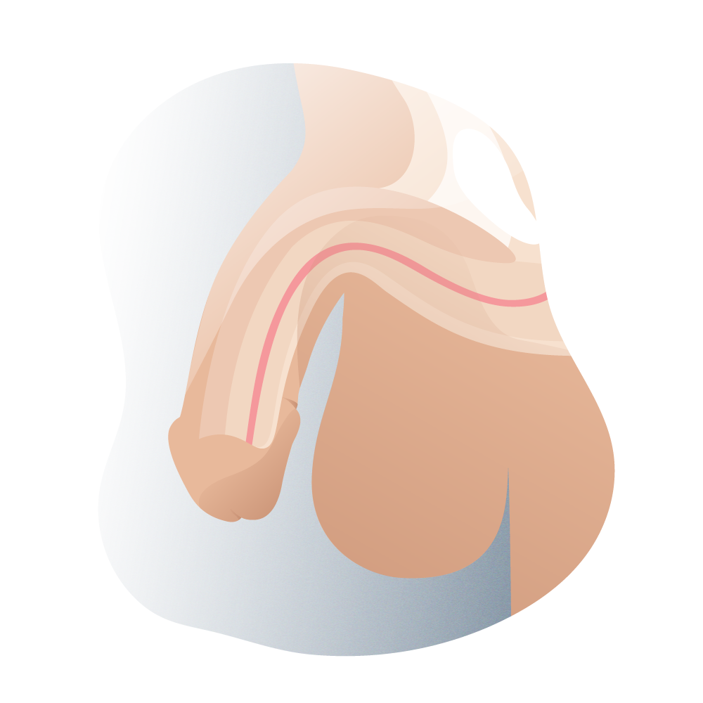 andromedi tipos de hipospadias segun su posicion lateral 01
