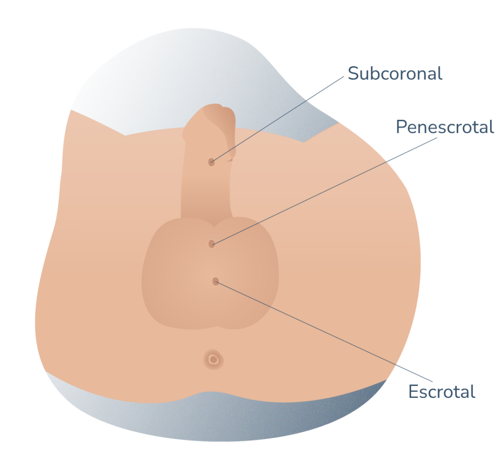 tipos de hipospadias segun su posicion