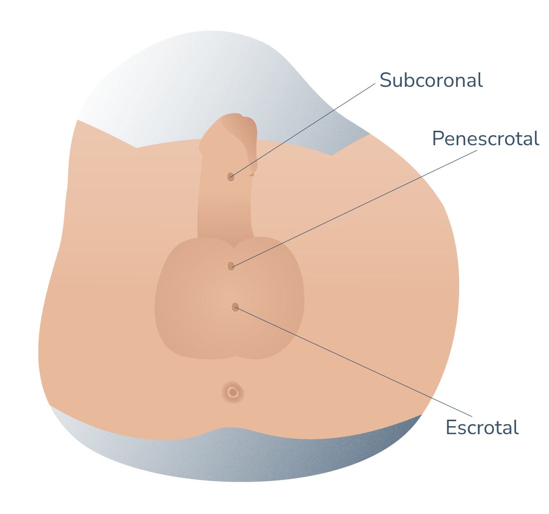 tipos de hipospadias segun su posicion