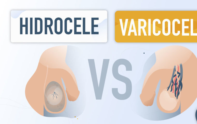 hidrocele versus varicocele