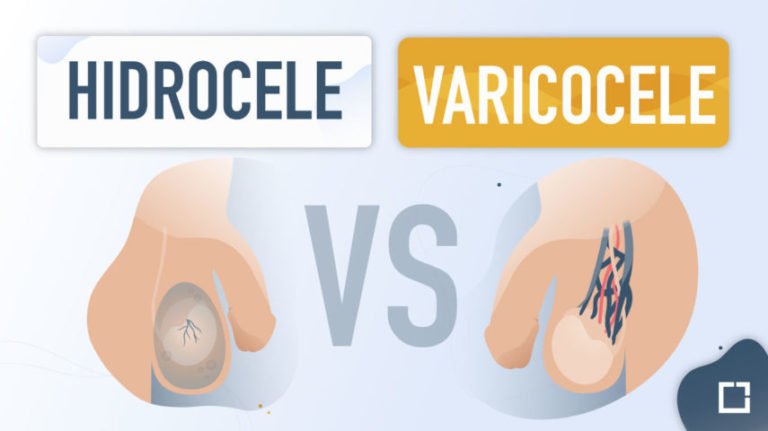 hidrocele versus varicocele