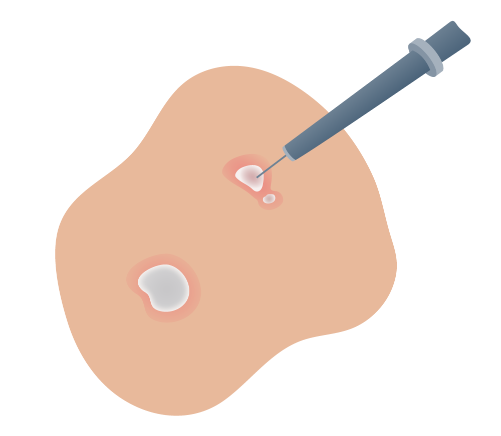 eliminar verruga manchas genitales con láser - paso 2