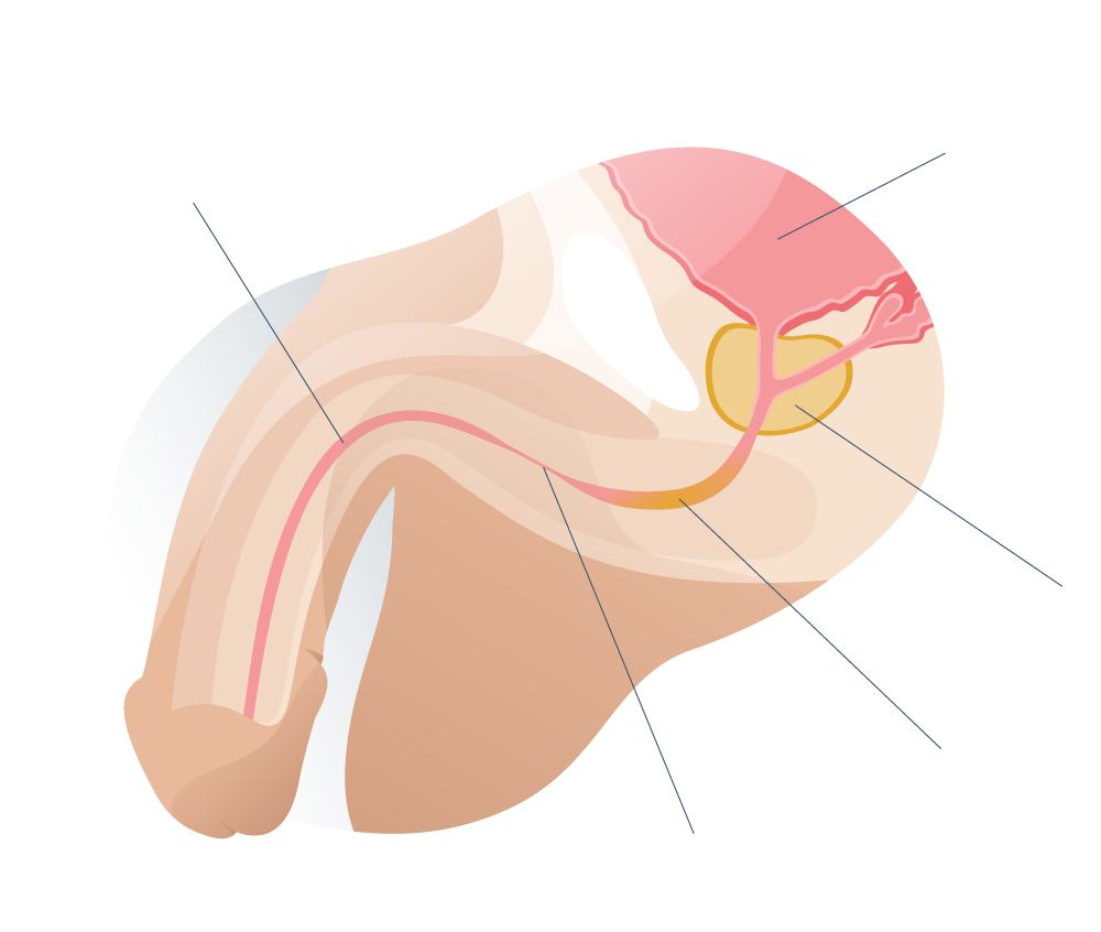 Estenosis de uretra vista lateral
