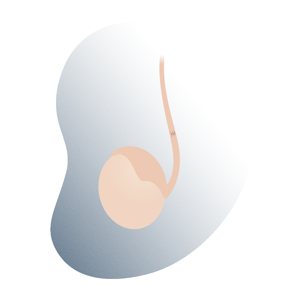 andromedi simplified view of vasectomy 02