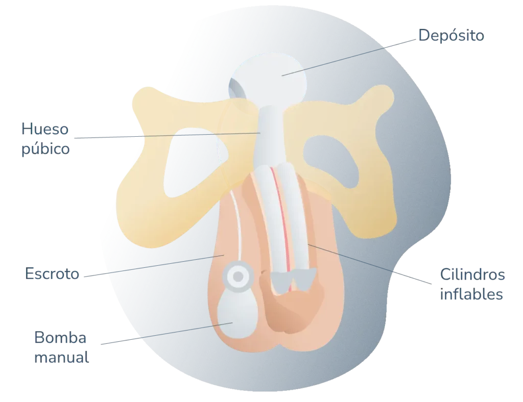 Cirugía Protesis de pene inflable Precio