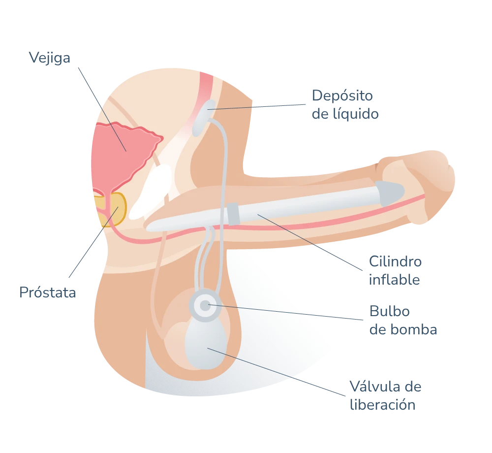 Cirugía Protesis hidraulica activa Precio