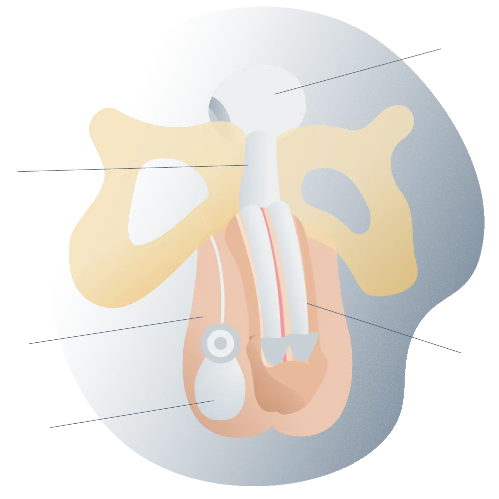 andromedi protesis de pene tipo hidrahulica 01 (1)