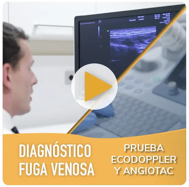 Video Cirugía Fuga venosa Eco Doppler y Angiotac (1)